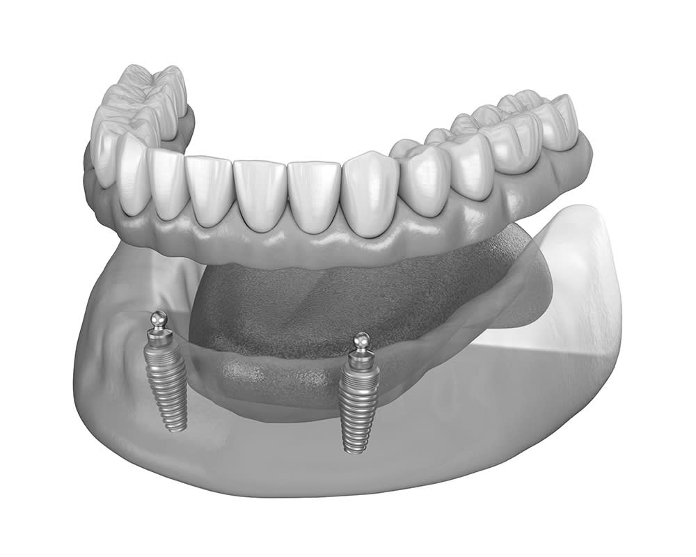 Prostheses Stabilized with Implants - Montreal