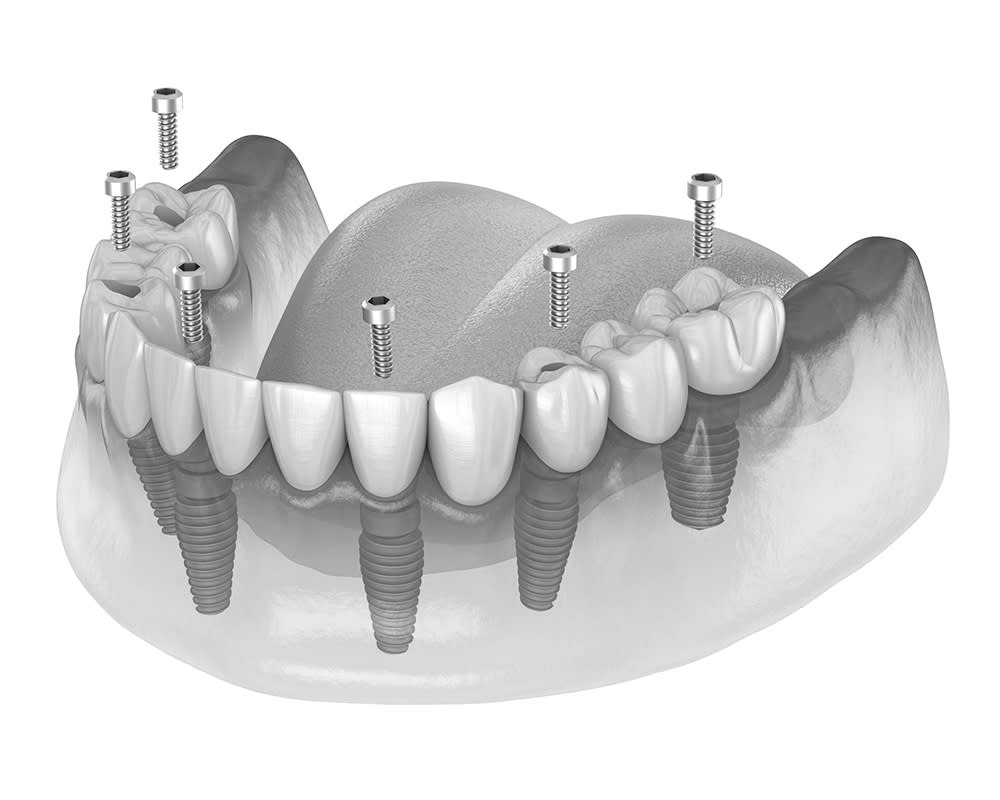 Full dental implants Montreal