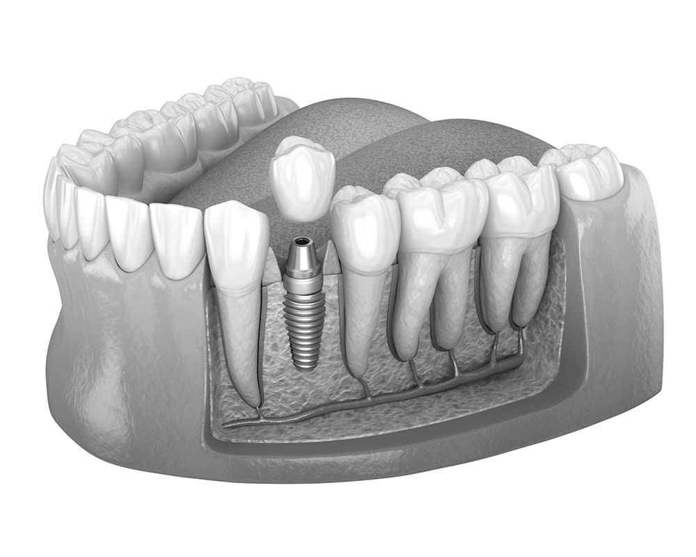 Loss of one or more teeth - dental implants